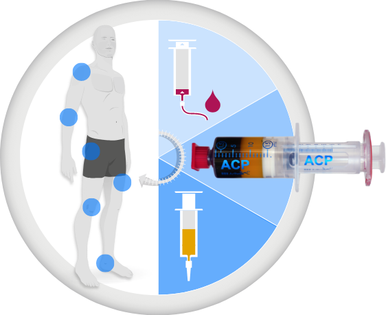 Eigenbluttherapie (ACP) – Knorpelzentrum NRW