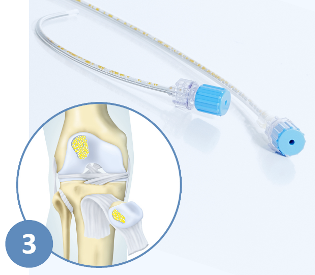 Knorpelzelltransplantation – Knorpelzentrum NRW